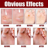 Feet Corn Removal Serum 30ml ( Pack Of 1 ) 16182